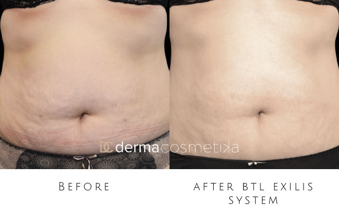exilis before after