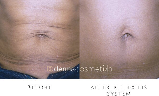 exilis before after