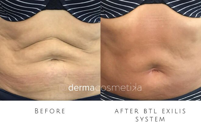 exilis before after
