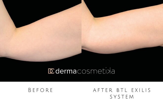 exilis before after