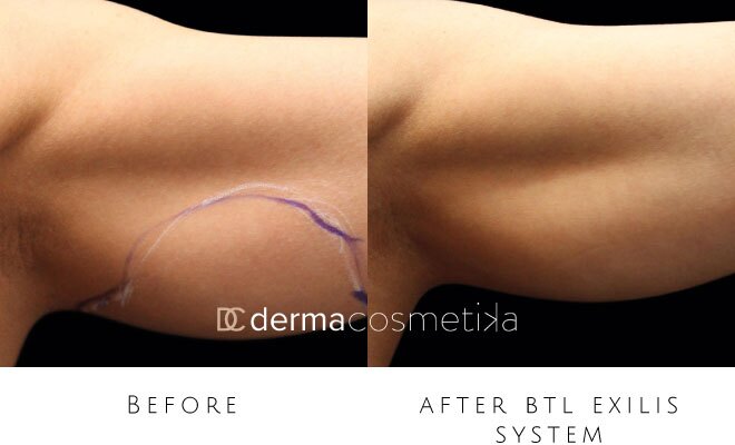 exilis before after