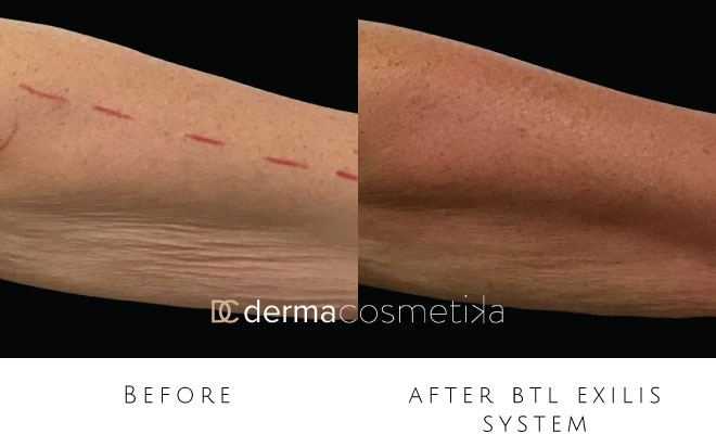 exilis before after