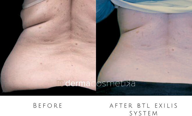 exilis before after