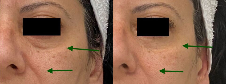anti wrinkle treatment