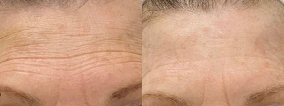 anti wrinkle treatment