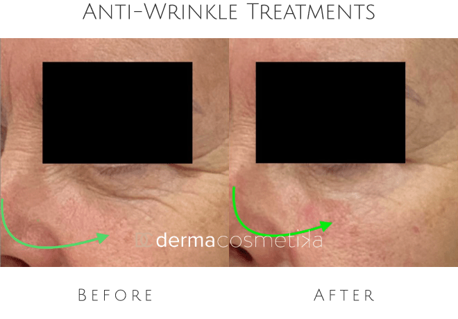 anti wrinkle treatments