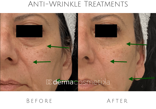 anti wrinkle treatments
