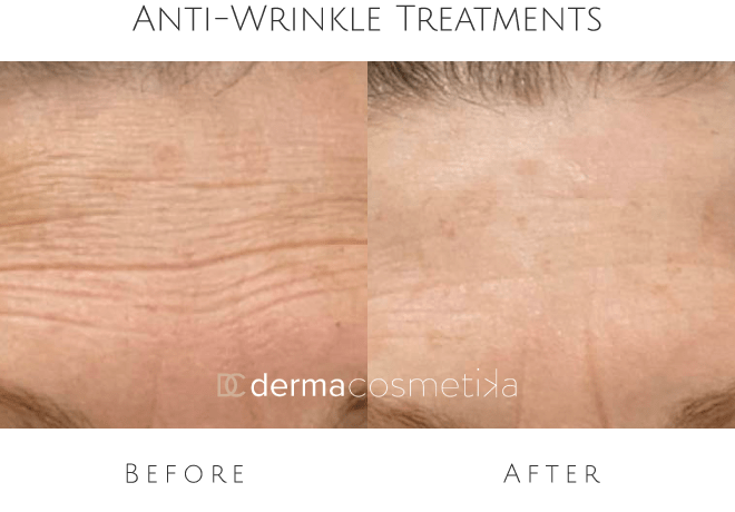 anti wrinkle treatments