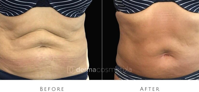 skin tightening before after