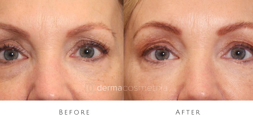 skin tightening before after
