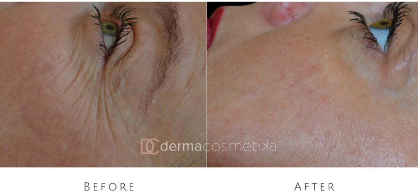 skin tightening before after