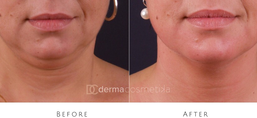 skin tightening before after
