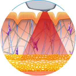 Exilis during treatment